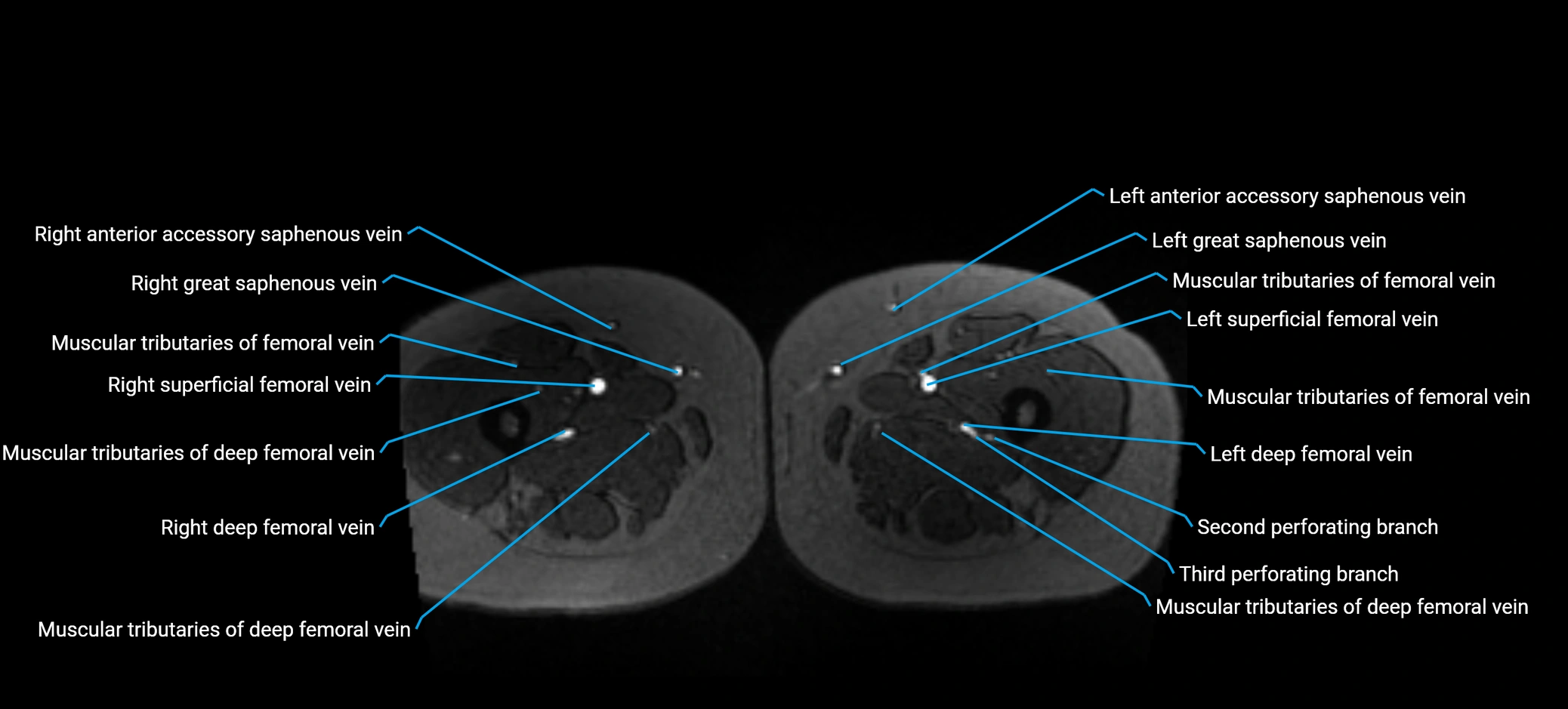 MRV abdomen pelvis & lower limb axial cross sectional anatomy labelled MRI image 247 (1).webp